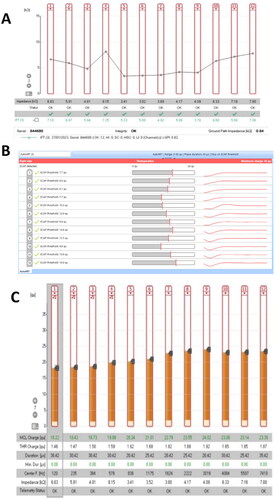 Figure 4. Adequate auditory responses after implant programming. (A) Impedance telemetry with adequate electrical responses in the 12 pairs of electrodes in the last programming session. (B) Postoperative automatic response telemetry of the auditory nerve (AutoART) which shows adequate responses of electrically evoked compound action potentials (eCAP) of the auditory nerve. The patient was found without any discomfort during the programming. (C) Levels (MCL-most comfortable loudness) in their last programming, which are balanced, sufficient and did not cause any discomfort for the patient. With these MCL levels, an audiogram is made which is within normal hearing parameters.