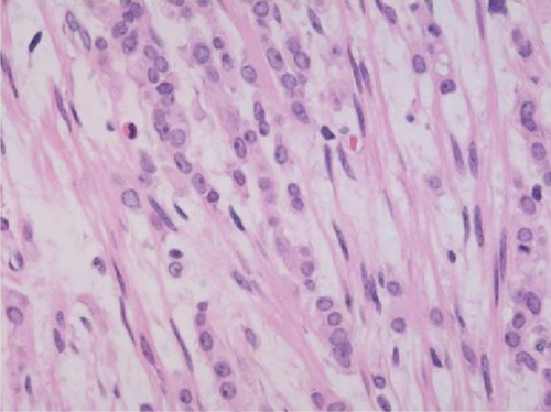 Figure 1. Histopathological findings of metastatic invasive lobular carcinoma from a peritoneal sample. The single file pattern of small cells is typical of invasive lobular carcinoma (hematoxylin and eosin, ×400 magnification).Reproduced from Osaku et al. (2015) [Citation7], licensed under CC BY 4.0.