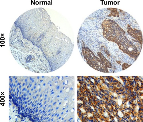 Figure 1 Representative IHC staining for the KIAA1522 protein in ESCC tumors and adjacent normal esophageal squamous epithelium.