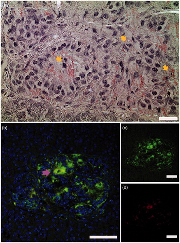 Figure 1. Islet amyloid was detected in pancreata obtained from patients newly diagnosed with type 1 diabetes. (a) a section from a pancreas tail biopsy stained with Congo red showing multiple islets with amyloid. Intracellular amyloid is associated with pyknotic cell nuclei indicated with yellow arrows. (b–d) IAPP was detected with a hIAPP specific antibody and visualized with an Alexa-488-labelled detection antibody (green), and amyloid by a subsequent staining with Congo red (red). Co-localization of IAPP immunoreactivity and amyloid (yellow) indicated by arrowhead in magenta ensures that amyloid is made up of IAPP. Bar 20 µm.