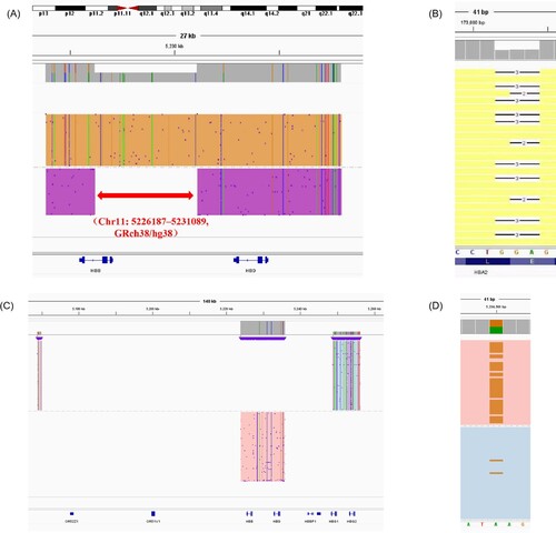 Figure 1. Integrative Genomics Viewer plots identified by TGS. The red arrow represents −4.9 kb deletion at chr16: 5226187–5231089 (A). The blank space represents αCD30(-GAG) in HBA2 (B). The colored part represents all the deletion of HBB and HBD and partial deletion of HBG(C). The brown color represents delta-thalassemia (c.−127T > C) in HBD (D).