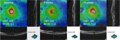 Figure 1 Optical coherence tomography scans in a case of branch retinal vein occlusion (eye 2).