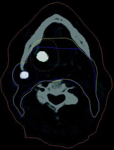 Figure 3.  Definition of the PET Clinical Target Volume. PET defined Gross Tumour Volume expanded with margin for microscopic spread and Conventionally defined CTV used as template to minimise intra-observer error. Labels: Cyan dashed: PET GTV primary expanded. Blue dashed: PET GTV node expanded. Blue: CT CTV. Yellow: PET CTV.