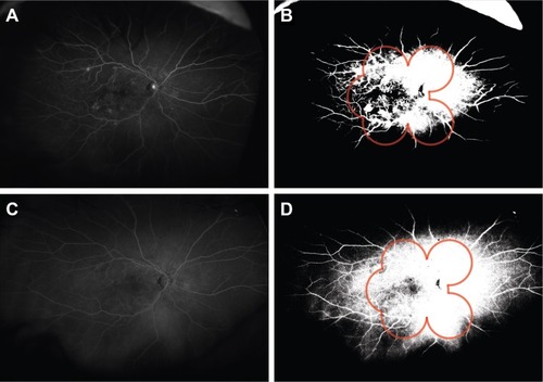 Figure 2 Reperfusion in eye of a 60-year-old female, following treatment with two injections of ranibizumab.