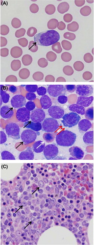 Figure 1. Peripheral smear with circulating blast (A), bone marrow aspirate demonstrating myeloblasts with lymphoid and erythroid precursor cells (B), and bone marrow biopsy consistent with acute myeloid leukemia (C).