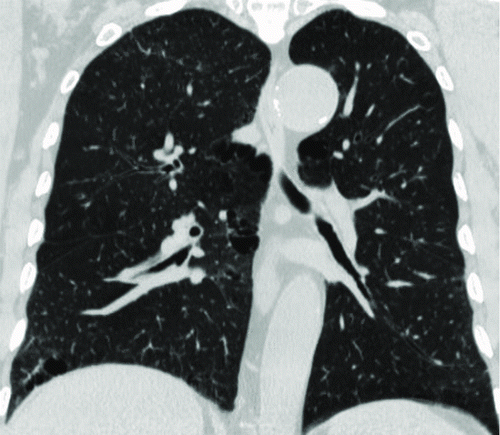 Figure 3.  A 76-year-old male with “mild COPD” (smoking index 50 pack-years, FEV1/FVC%, 69.57%; % FEV1, 83.1%). (Fig. 3a) Coronal non-enhanced CT shows located emphysematous regions in both upper lung fields and right lower lung field. (Fig. 3b–Fig. 3c) Coronal perfusion image acquired with DCE-MRI shows multiple patchy perfusion defects in left upper and lower lung fields, except for the perfusion defects on the corresponding emphysema regions.