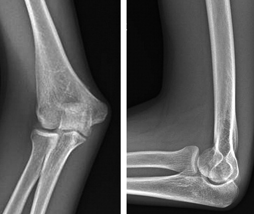 Figure 2. A radiographic investigation (antero-posterior and lateral projections) of the elbow showing an increased carrying angle 9 years after the injury. The patient (case IV) was 14 years old when he sustained a Gartland-Wilkins type-IV supracondylar humerus fracture.