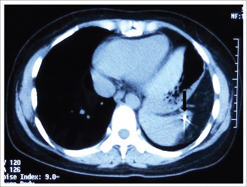 Figure 4. Abdominal CT after radiotherapy: The patient was treated with Cyberknife for her spleen lesion. Abdominal CT showed that the spleen metastasis reduced to 2.6 cm × 3.5 cm at one month follow up.