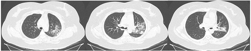 Figure 1 The patient’s lung CT scan displayed a significant area of pneumonia predominantly in the left lung.