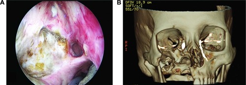 Figure 1 Case 1: (A) Endoscopic photograph of the right nasal cavity showing the palatal defect, exposed bone of the lateral wall in the area of maxillary sinus and altered anatomy of the lateral wall. (B) The 3D CT-DCG showed absence of the right maxilla with right dilated lacrimal sac and an abrupt obstruction at the sac–duct junction. The DCG findings of the left lacrimal apparatus were normal.