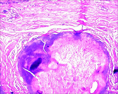 Figure 5 Multiple degenerative nodules with calcification and focal ossification were seen in the Microscope with a small amount of inflammatory cell infiltration (HE×200).