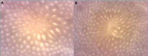 Figure 2. Two examples of heterogeneous (or ill-defined) aberrant crypt focus (ACF) as observed on the colonic mucosal surface after Bouin's fixation in Study 2. The ACF are the foci of large, darkly staining enlarged crypts bordering an infolding pattern over what appears to be a lymphoid follicle. Faint outlines of the openings of small crypts are seen at the center of both ACF. (The mucosal fields are 1.7 × 0.8 mm and 2.7 × 1.3 mm.)