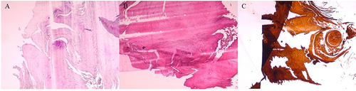 Figure 2 Hematoxylin-eosin (HE) staining (A), periodic acid-Schiff staining (PAS) (B), and periodic acid-silver methenamine (PASM) staining (C) of nail keratinocytes and fibrous connective tissue on the bottom of the fingernails.