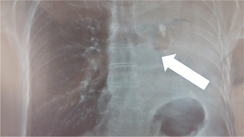 Figure 1 Left lung atelectasis (during abraxane, last therapy session); white arrow indicates the central mass to the left main bronchus.