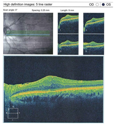 Figure 2 Optical coherence tomography findings on initial presentation of case 4. Retinal thickening and epiretinal membrane are evident.