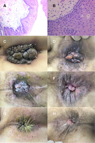 Figure 1 A lesional skin biopsy from perianal giant CA showed: verrucous hyperplasia of squamous epithelium with Koilocyte cells (A) ×40, (B) ×100. Clinical manifestations before treatment (C). Elimination of giant perianal CA lesions after nearly 1 year’s treatment with paiteling (D–G). No relapse appeared 10 months after the treatment finished (H).
