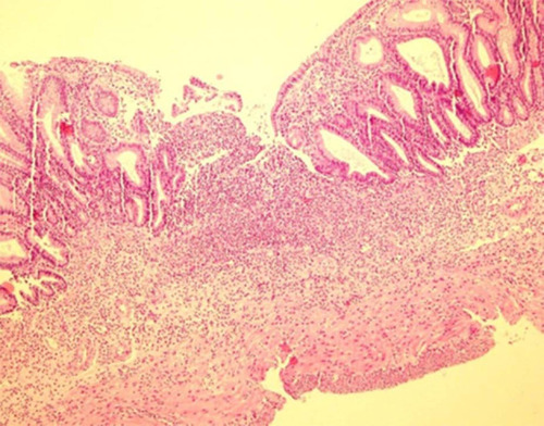 Figure 4 Microscopic section shows severe transmural acute inflammation with crypt and epithelium lost in colitis group. (Hematoxylin and Eosin, 100×).