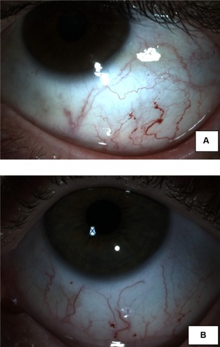 Figure 3 Conjunctival tortuosity with aneurysms presenting as an out–pouching.