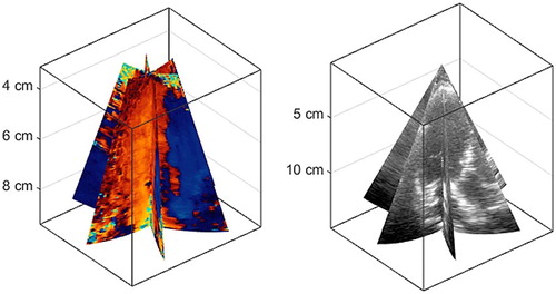 Figure 1. Triplane color Doppler in a left ventricle. Left panel: color Doppler. Right panel: B-mode imaging. The goal of 3D-iVFM is to reconstruct the intraventricular blood flow from these clinical data.