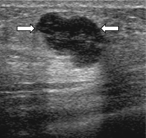 Figure 2.  A 42-year-old female with a grade 3 invasive ductal carcinoma. Ultrasound shows an irregular shaped, circumscribed marginated, hypoechoic, parallel orientated mass (arrows) with an abrupt boundary and no internal calcifications. The cancer was ER and PR negative, and HER-2/neu negative.