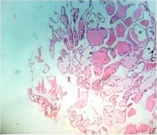 Figure 6. photomicrograph of prostate tissue section of a rat from group 6 (BPH-induced and treated with 200 mg/kg of MF) showing extended papillary projections (black arrow) although there are more intra acinar papillary infoldings with reduced intraluminal secretions (star). H&E. mag. 400X.