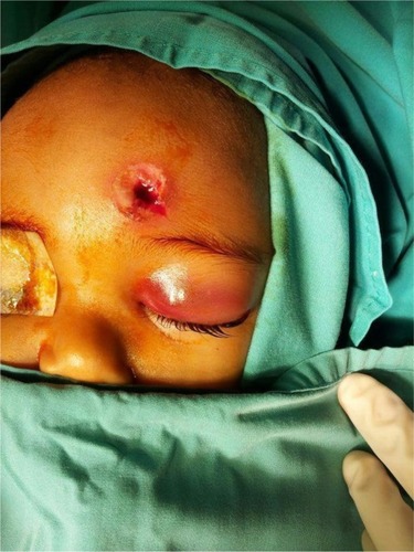 Figure 1 Gunshot-like wound over the forehead with left preseptal cellulitis.