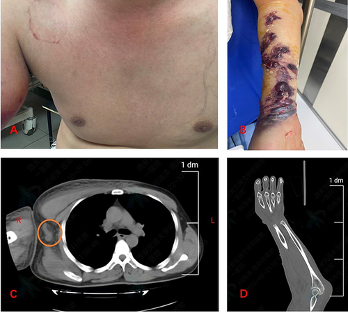 Figure 1 (A) The congestive right chest. (B) Purple and faint yellow blisters in right forearm. (C) Swollen soft tissue of the chest wall and swollen lymph nodes (the area circled) on the right armpit in CT. (D) Swollen right forearm and elbow joint.