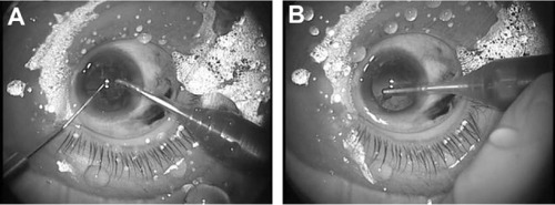 Figure 5 LiDrape® in PEA and IOL implantation. (A) Chopping and aspiration of the nucleus, using ultrasound. (B) Cortex aspiration.