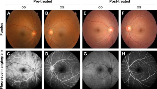 Figure 10 Represents the color fundus photo and fundus fluorescein angiography of the right and left eye at pre-treatment and post-treatment phases.