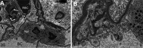Figure 6 Ultrastructure changes in podocytes and mesangial cells in NiNP-treated rat kidney. (A) Degeneration of podocytes showing the fusion of foot processes (effacement) (arrows). Mesangial cells appeared degenerated having fragmented nucleus (black arrows). Neutrophil in the blood capillary showing phagocytosis of the degenerating mesangial cells. (B) Enlargement of (A) showing the phagocytosis process and engulfing of apoptotic bodies of mesangial cells and fusion of foot processes of podocytes.Note: P1, primary podocyte foot processes; P2, secondary podocyte foot processes. Abbreviations: NiNPs, nickel nanoparticles; P, podocytes; RBC, red blood cells; BC, blood capillary; MC, mesangial cells; Npl, neutrophil; ap, apoptotic bodies.