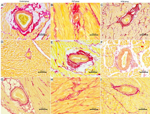 Figure 4. The histological image of the intramural arteries in the examined cats. Picro sirius red stain; 200× magnification. (A, D, G) Control group; (B, E, H) FHT group; (C, F, I) HCM group; (A–C) left ventricular free wall; (D–F) interventricular septum; (G–I) right ventricular free wall. IVS: interventricular septum; LVW: left ventricular free wall; RVW: right ventricular free wall.