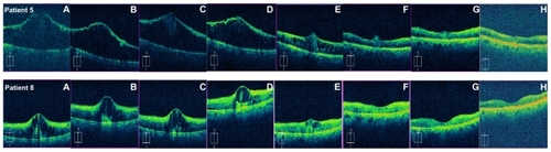 Figure 1 Representative spectral domain optical coherence tomography scans from two patients showing the macula at (A) prior to intravitreal injection, (B) 1 hour, (C) 3 hours, (D) 6–9 hours, (E) 24 hours, (F) 48 hours, (G) 1 week, and (H) 1 month following injection. Patient 5 (top) received an injection of triamcinolone 4.0 mg while patient 8 (bottom) received bevacizumab 1.25 mg.