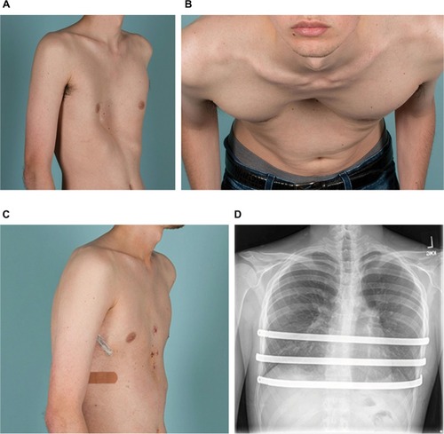 Figure 3 Clinical photographs of a 22-year-old man with severe pectus excavatum are shown before surgery (A, B) and after (C) minimally invasive repair of pectus excavatum, with placement of three Nuss bars as shown in the chest roentgenogram (D).