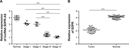 Figure 1 Downregulation of both SDPR-AS and SDPR expression in RCC tissue samples.