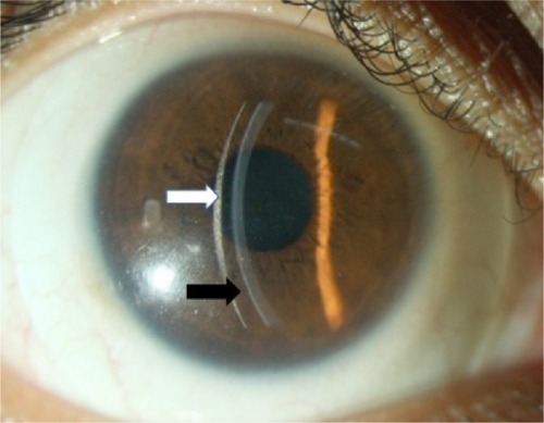 Figure 1 Corneal clearance on slit lamp biomicroscopy.