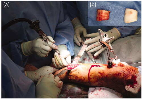 Figure 7. (a) Tibial osteotomy using the navigation system. (b) One of the resected bone fragments and a corresponding bone model. The actual resected bone fragments are smaller than the model for the width of the burr bit.