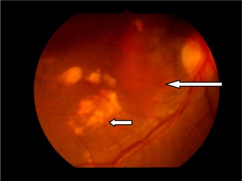 Figure 3 Patient 10 with idiopathic polypoidal choroidal vasculopathy. Orange subretinal lesion (long arrow) and subretinal exudates (short arrow).