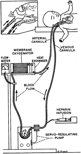 Figure 8. The ECMO mechanism, as depicted by Bartlett et al. (Citation1976).