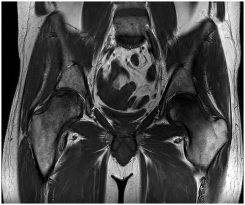Figure 1. Bilateral osteonecrosis, coronal T1 weighted MRI. 16 months after diagnosis of ES, 2 May 2014. Note that the MR scan fits chronologically between CT scans (B) and (C) in Figure 2.