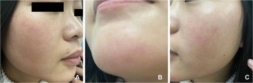 Figure 4 The lesions completely disappeared after one week of treatment with 0.2% ketoconazole cream (twice daily) (A–C). Images of the patient’s right cheek (A), chin (B) and left cheek (C) after the treatment.