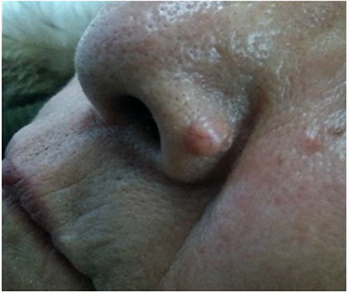 Figure 1 A skin color, semicircular nodule on the left side of the alar of the nose, with telangiectasis on the surface.