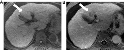 Figure 6 Contrast enhanced MRI of abdomen (extracellular agent) shows a focal hepatic lesion in segment III (arrow) which is iso-intense to the surrounding liver parenchyma (no hyper-enhancement) in the arterial phase (A) and “washout” of the contrast in the delayed phase (B).