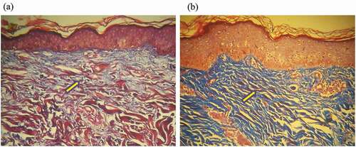 Figure 3. Histopathology of the percentage area of collagen (100x magnification) in the study subjects in the 0.1% tretinoin cream group, pre therapy (A) and post therapy (B). Yellow arrows indicate an increase in the amount of collagen