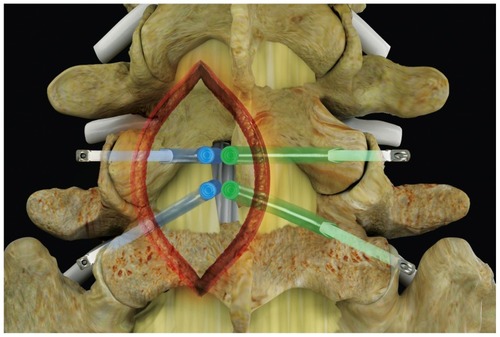 Figure 1 Posterior spine indicating the four nerve roots traversing and exiting on the ipsilateral and contralateral side, decompressed through a single interlaminar access point.