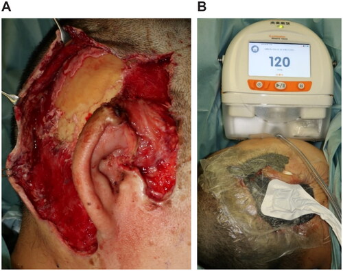 Figure 3. Second surgery, 12 days after. (A) After debridement, the extracranial plate is exposed. (B) Applying NPWT (RENASYS⋄ TOUCH, Smith & Nephew) with a negative pressure of −120 mmHg.