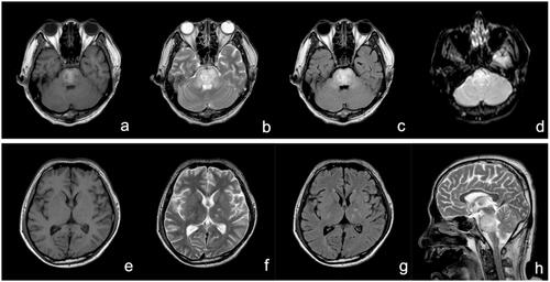 Figure 2. MRI 13 days after ingestion showing abnormal high-intensity in the pons, bilateral brachium pontis, and pedunculus cerebri on T1WI (a), T2WI (b and h), and T2-FLAIR (c), and slight high-intensity on DWI (d); The bilateral caudate nucleus, putamen, thalamus, and corona radiata showed abnormal low-intensity on T1WI (e) and abnormal high-intensity on T2WI (f) and T2-FLAIR (g). DWI: diffusion-weighted imaging; FLAIR: fluid attenuated inversion recovery; MRI: magnetic resonance imaging.