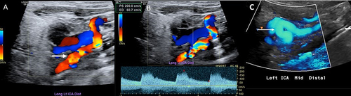 Figure 3 Colour Doppler imaging (A) of the distal internal carotid artery exhibiting the typical pattern of tortuosity and marked turbulence. Colour Doppler imaging (B) showing turbulence and spectral analysis demonstrating high peak velocity (200 cm/s). Colour power angiography (C) demonstrates severe tortuosity of the distal carotid artery with redundancy.