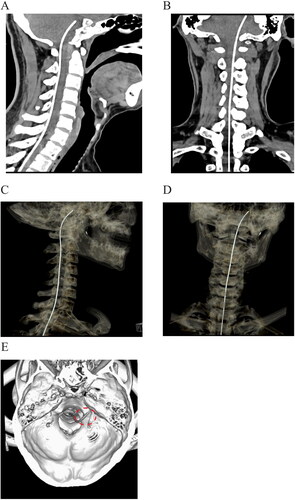 Figure 2. Postoperative imaging of catheter placement with computed tomography. a, b: Sagittal and coronal plane of scanning demonstrated that the tip of intrathecal catheter was located at the level of posterior clinoid process. c, d: Three-dimensional reconstruction of catheter placement by computed tomography. e: Reconstruction of the skull base to reveal the location of the catheter (circled by the red dash line).