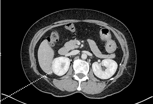 Figure 3 Assessing the tract from the right twelfth rib tip to the right kidney.