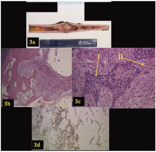 Figure 3. (a–d) Gross image and pathology of tibial lesion. A longitudinal section shows a 9.2 × 3.6 × 2.7 cm intramedullary tumor that involves the cortex (3a). Low power (3b) and high power (3c) views demonstrate a lesion with a biphasic pattern characterized by epithelial islands (Arrow I) surrounded by an abundant fibrous stroma (Arrow II). Figure 3(d) shows the epithelial component demonstrating positivity for pan keratin.